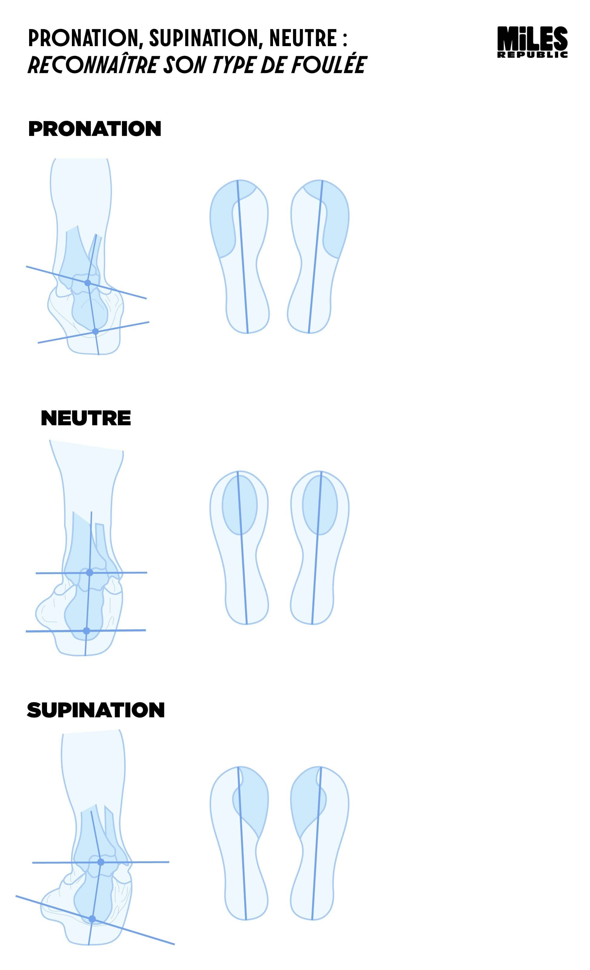 Type de foulée pronatrice, supinatrice, neutre
